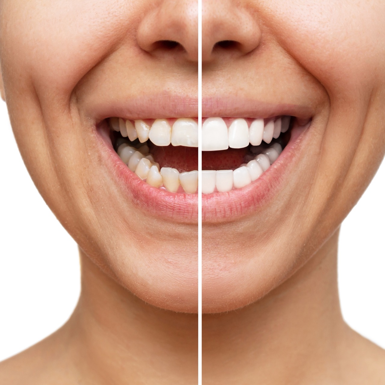 66ddd8aa67c5af65014a8265_cropped-shot-young-woman-before-after-veneers-installation-comparison-shape-teeth Large